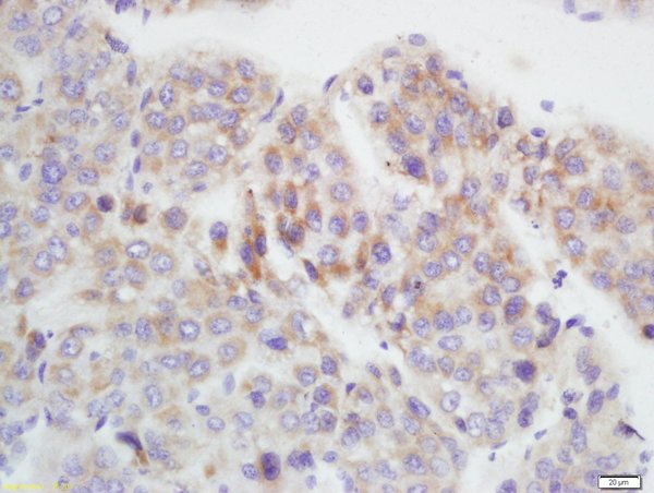 Formalin-fixed and paraffin embedded human hepatocellular carcinoma labeled with Anti-GAMT Polyclonal Antibody, Unconjugated (bs-13278R) at 1:200 followed by conjugation to the secondary antibody and DAB staining.