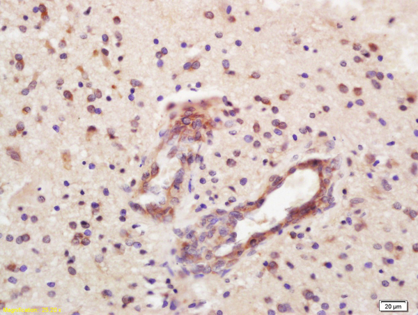 Formalin-fixed and paraffin embedded human glioma labeled with Rabbit Anti-CD32 Polyclonal Antibody, Unconjugated (bs-2573R) at 1:200 followed by conjugation to the secondary antibody and DAB staining\\n