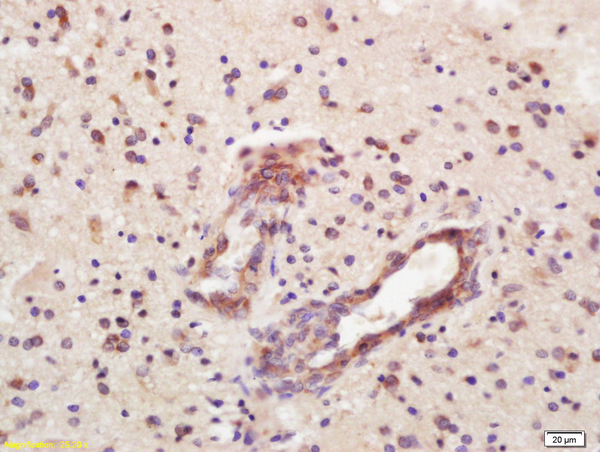 Formalin-fixed and paraffin embedded human glioma labeled with Rabbit Anti-CD32 Polyclonal Antibody, Unconjugated (bs-2573R) at 1:200 followed by conjugation to the secondary antibody and DAB staining\n