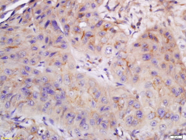 Formalin-fixed and paraffin embedded human laryngocarcinoma labeled with Anti-CYB5R4 Polyclonal Antibody, Unconjugated (bs-14133R) at 1:200 followed by conjugation to the secondary antibody and DAB staining. Formalin-fixed and paraffin embedded human laryngocarcinoma labeled with Anti-CYB5R4 Polyclonal Antibody, Unconjugated (bs-14133R) at 1:200 followed by conjugation to the secondary antibody and DAB staining.