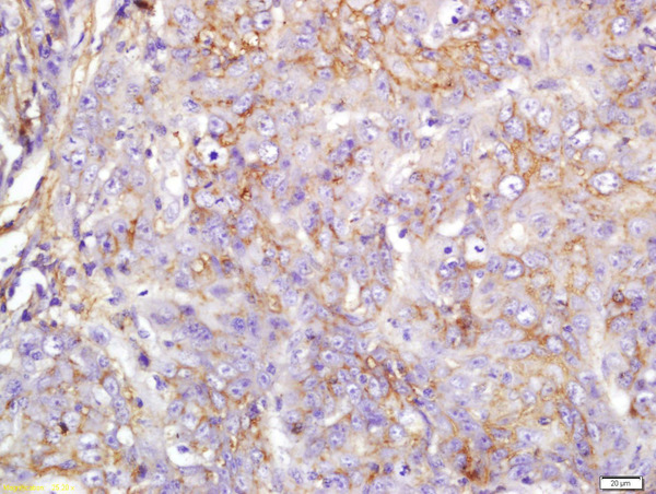 Formalin-fixed and paraffin embedded human larynocarcinoma labeled with Anti-eIF4H Polyclonal Antibody, Unconjugated (bs-14553R) at 1:200 followed by conjugation to the secondary antibody and DAB staining.
