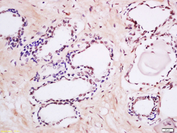 Formalin-fixed and paraffin embedded human prostate labeled with Anti-MAK (Tyr159) Polyclonal Antibody, Unconjugated (bs-18634R) at 1:200 followed by conjugation to the secondary antibody and DAB staining.\n